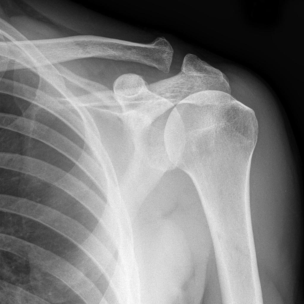 рентген плечевого сустава