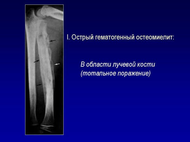 Воспаление кости на рентгене