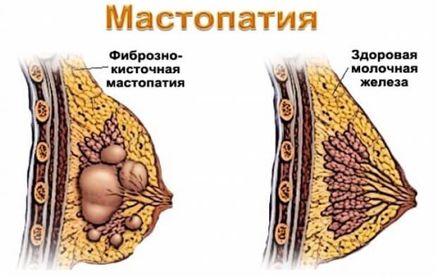 Мастопатия у женщин