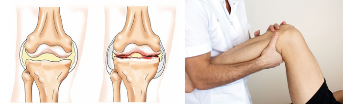 Коксартроз и гонартроз