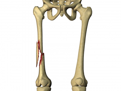 Перелом бедренной кости
