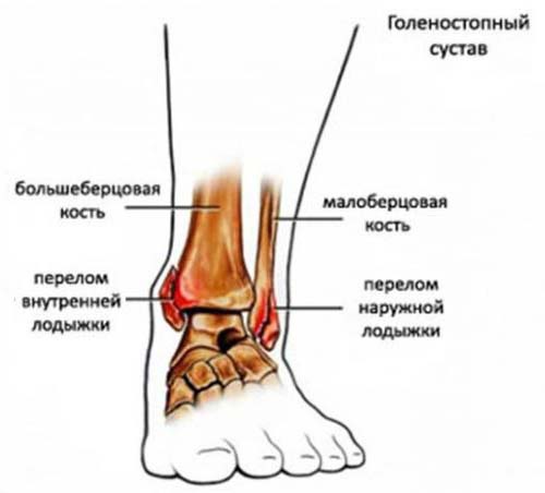 Перелом лодыжки