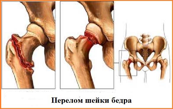 Перелом шейки бедра