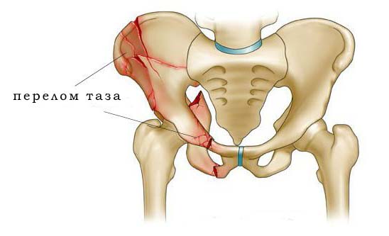 Перелом таза
