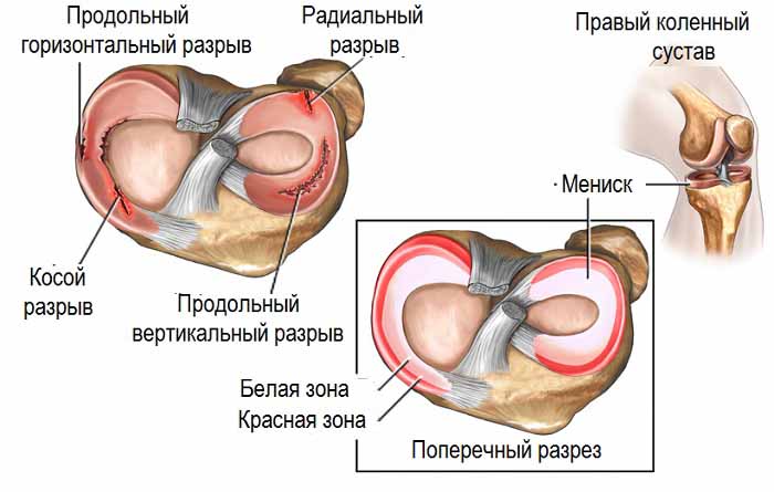 Разрыв мениска