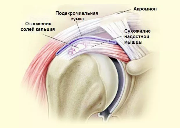 Лечебная физкультура при тендините, болезни сухожилий