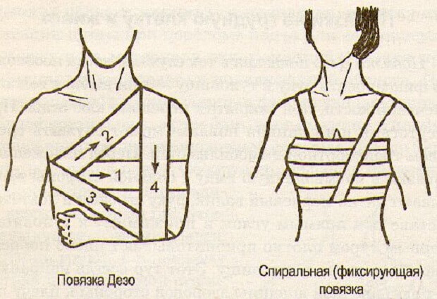 Перевязка дезо