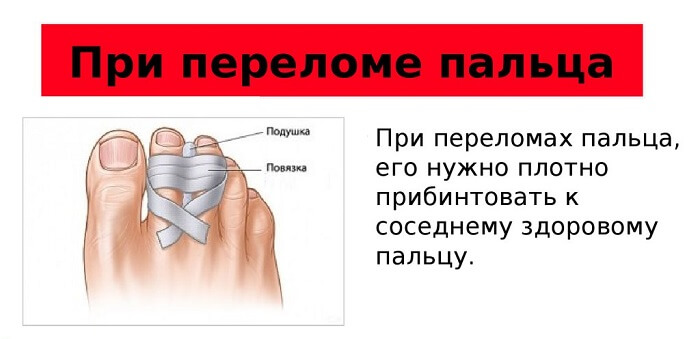 Что делать при переломе пальца