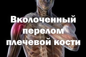 Вколоченный перелом плечевой кости