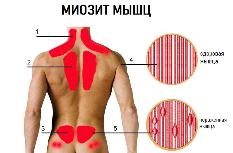 Поражение миозитом мышц