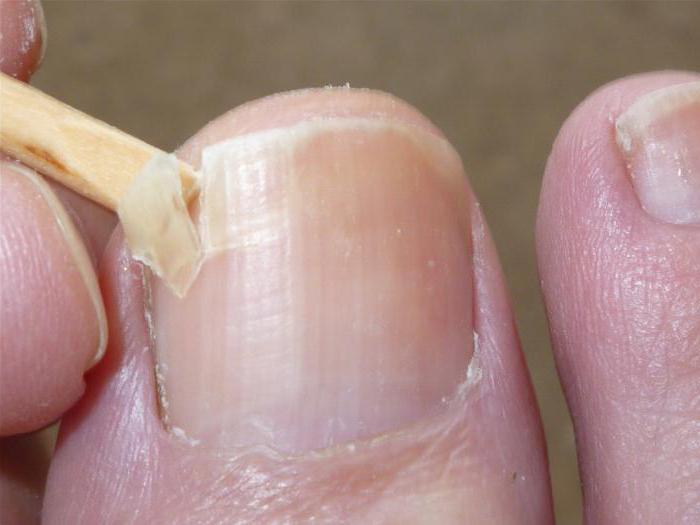 Причиной повреждения ногтевой пластины может быть травма