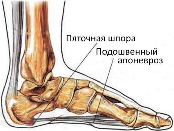 Болят пятки при ходьбе, больно наступать. Причины, чем лечить кожу стоп в домашних условиях