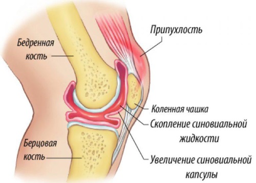 Боль в колене сбоку с внутренней стороны, внешней, наружной, от и до бедра. Причины и лечение. К какому врачу обратиться