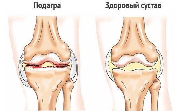 Боль в колене сбоку с внутренней стороны, внешней, наружной, от и до бедра. Причины и лечение. К какому врачу обратиться