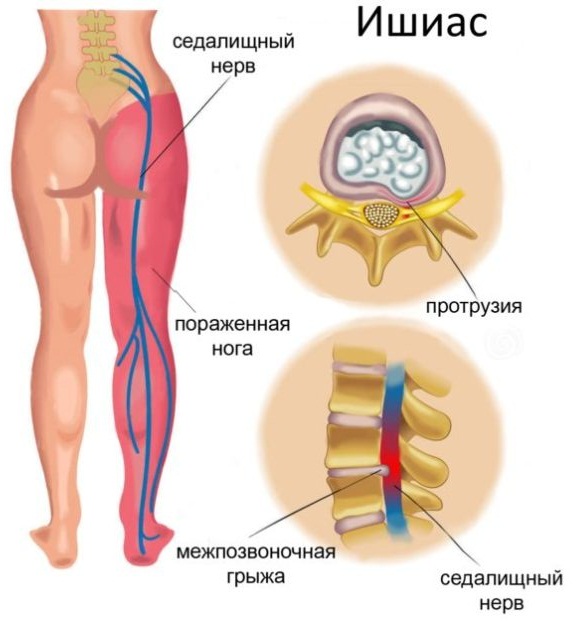 Боли в коленях. Причины, лечение при сгибании, разгибании, ходьбе, приседании и вставании. Народные средства, мази, лекарства, уколы