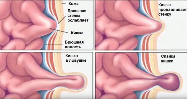 Паховая грыжа у женщин: симптомы, лечение без операции, народными средствами. Операция по удалению, последствия