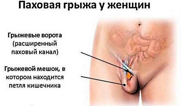 Паховая грыжа у женщин: симптомы, лечение без операции, народными средствами. Операция по удалению, последствия