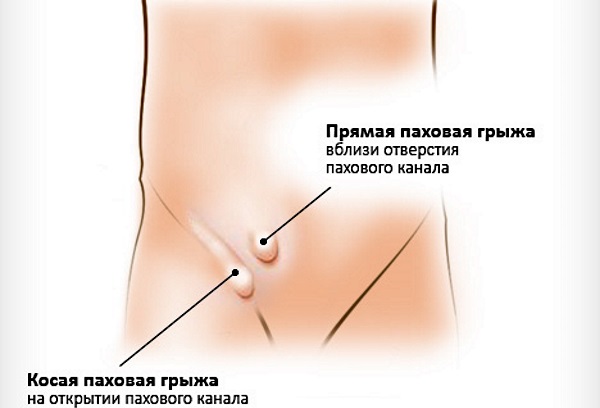 Паховая грыжа у женщин: симптомы, лечение без операции, народными средствами. Операция по удалению, последствия