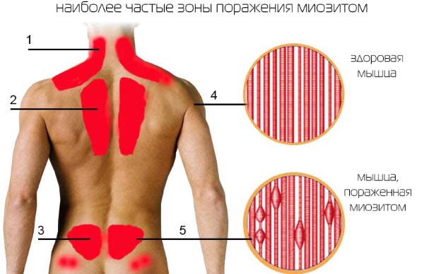 Шишка под кожей на руке, шее, лице, спине. Фото высыпания в виде бугорков. Причины и лечение