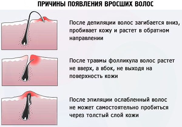 Шишка под кожей на руке, шее, лице, спине. Фото высыпания в виде бугорков. Причины и лечение