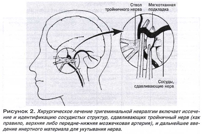 Тройничный нерв. Воспаление, симптомы, анатомия, где находится, схема лечения