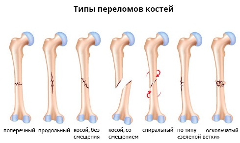 Упражнения при болях поясницы, грыже, остеохондрозе для женщин, мужчин по Бубновскому