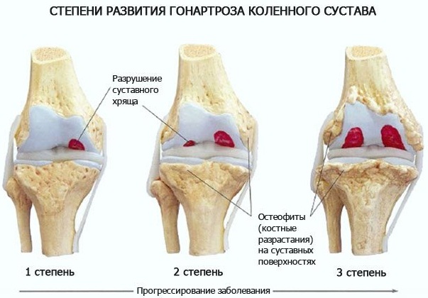 Остеоартроз коленного сустава. Лечение, что это такое, препараты, лечебная гимнастика, упражнения