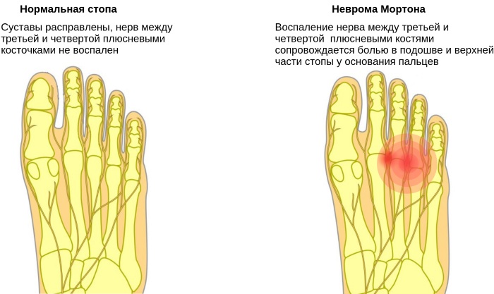 Неврома стопы (неврома Мортона). Симптомы и лечение, признаки, к какому врачу обращаться