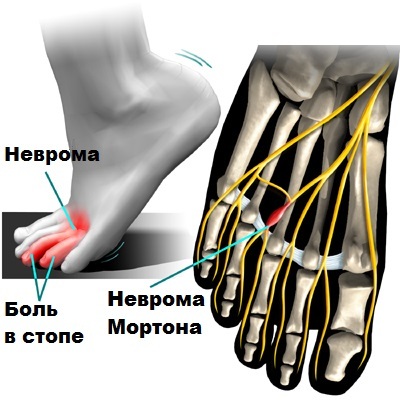 Неврома стопы (неврома Мортона). Симптомы и лечение, признаки, к какому врачу обращаться