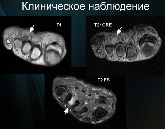 Неврома стопы (неврома Мортона). Симптомы и лечение, признаки, к какому врачу обращаться