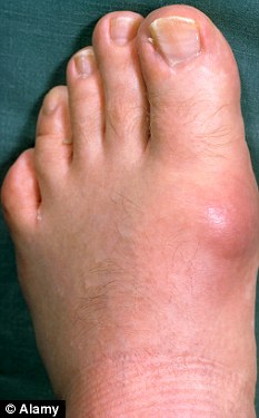 Gout is caused by a build up of uric acid that form crystals in the joints, most commonly in the toes and feet