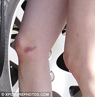 Action hero: Emma had the bruise on her right leg