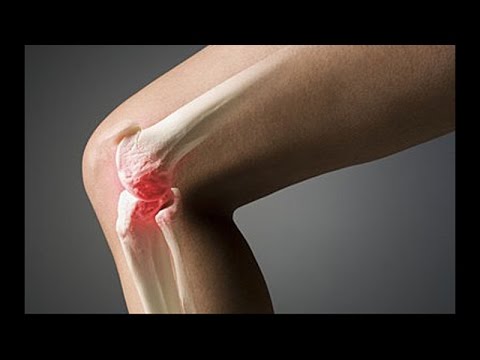 Артроз коленного сустава. Как укрепить колени - YouTube