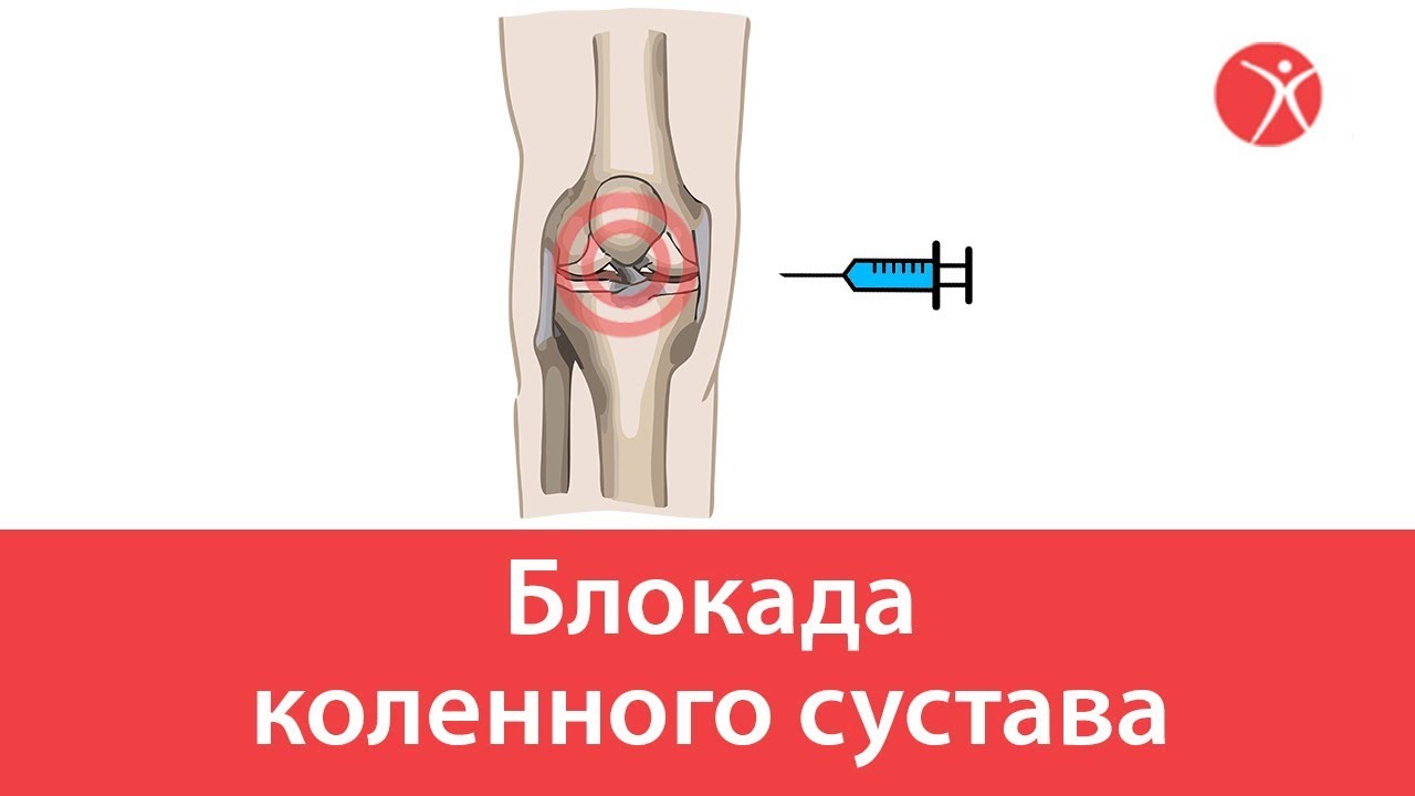 Препарат для блокады коленного сустава
