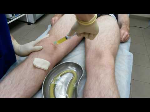 Симптомы и методы лечения разрыва передней крестообразной связки коленного сустава