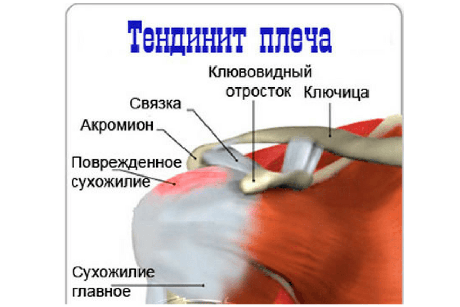 Боль в плечевом суставе правой руки. Тендинит сухожилия бицепса плечевого сустава. Воспаление сухожилия подостной мышцы. Воспаление в сухожилии надостной мышцы. Тендинопатия сухожилия надостной мышцы плечевого сустава.