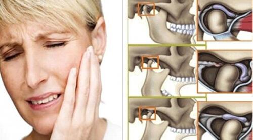 При открытии рта болит ухо. Травматический артрит ВНЧС. Челюстью(дисфункция ВНЧС). Артрит височно-нижнечелюстного сустава симптомы. Эндопротезирование височно-нижнечелюстного сустава (ВНЧС).
