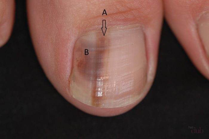 отложение меланина в ногтевой пластине