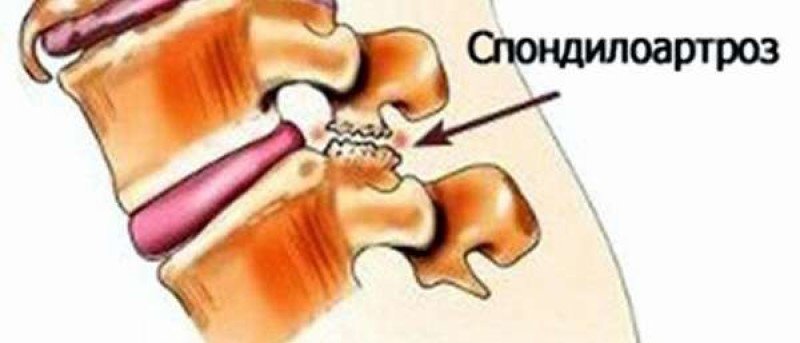 Спондилоартроз пояснично крестцового что это. Спондилоартроз межпозвонковых суставов поясничного отдела. Дугоотросчатые суставы позвоночника спондилоартроз. Остеохондроз спондилез спондилоартроз грудного отдела позвоночника. Спондилоартроз 2 степени грудного отдела позвоночника.