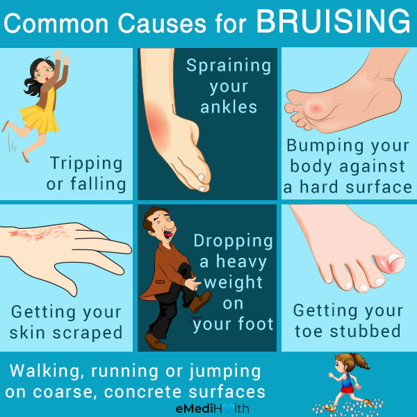 bruising causes