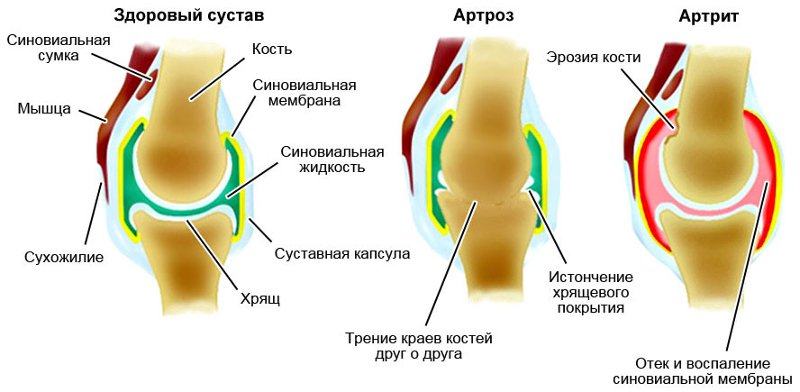 В чем разница между артритом и артрозом?