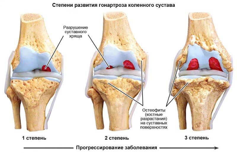 Степени развития гонартроза коленного сустава