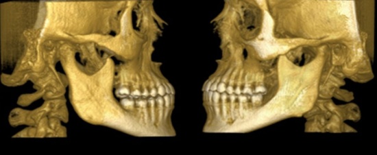трехмерный снимок челюстно-лицевого сустава