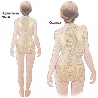 Нормальная спина и сколиоз