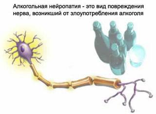 Посттравматическая нейропатия лучевого нерва мкб 10