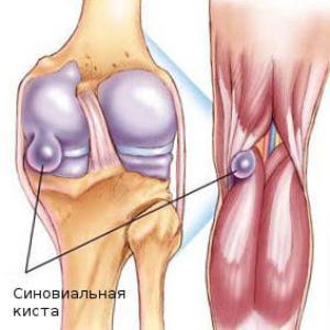 Ганглиевая киста коленного сустава: симптомы, диагностика и лечение