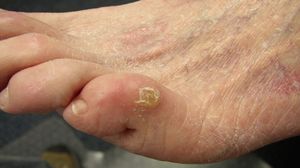 Лечение нароста на пальцах ног
