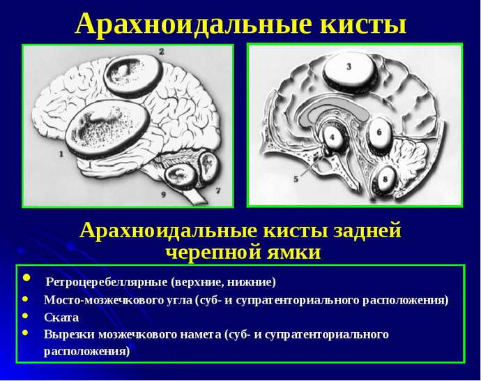 гигрома головного мозга
