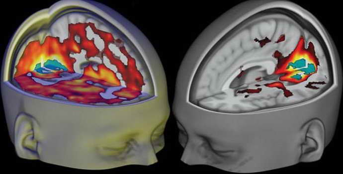 Гигрома головного мозга: причины, симптомы, лечение