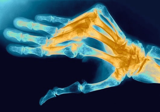 Полиартрит пальцев рук: лечение суставов, причины и симптомы